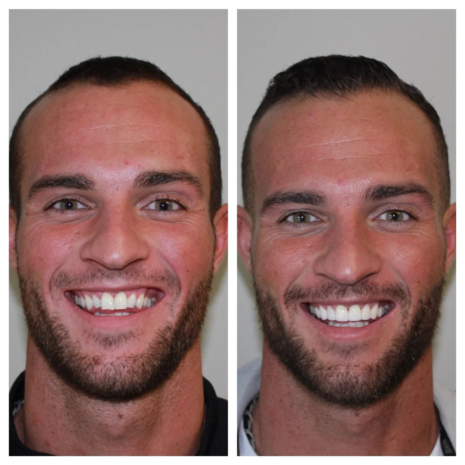 Teeth whitening